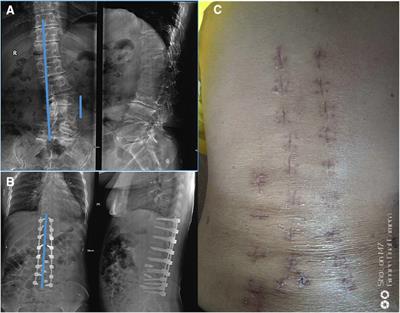 Case Report: Adult degenerative scoliosis in two patients treated with percutaneous spinal endoscopic-assisted lumbar interbody fusion and percutaneous pedicle screw fixation